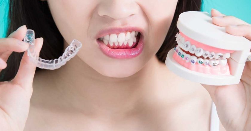Things to Consider Before Going WIth Invisalign!