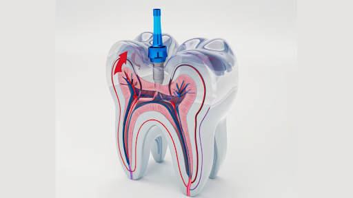Root Canal Treatment in Dubai: Myths vs. Reality
